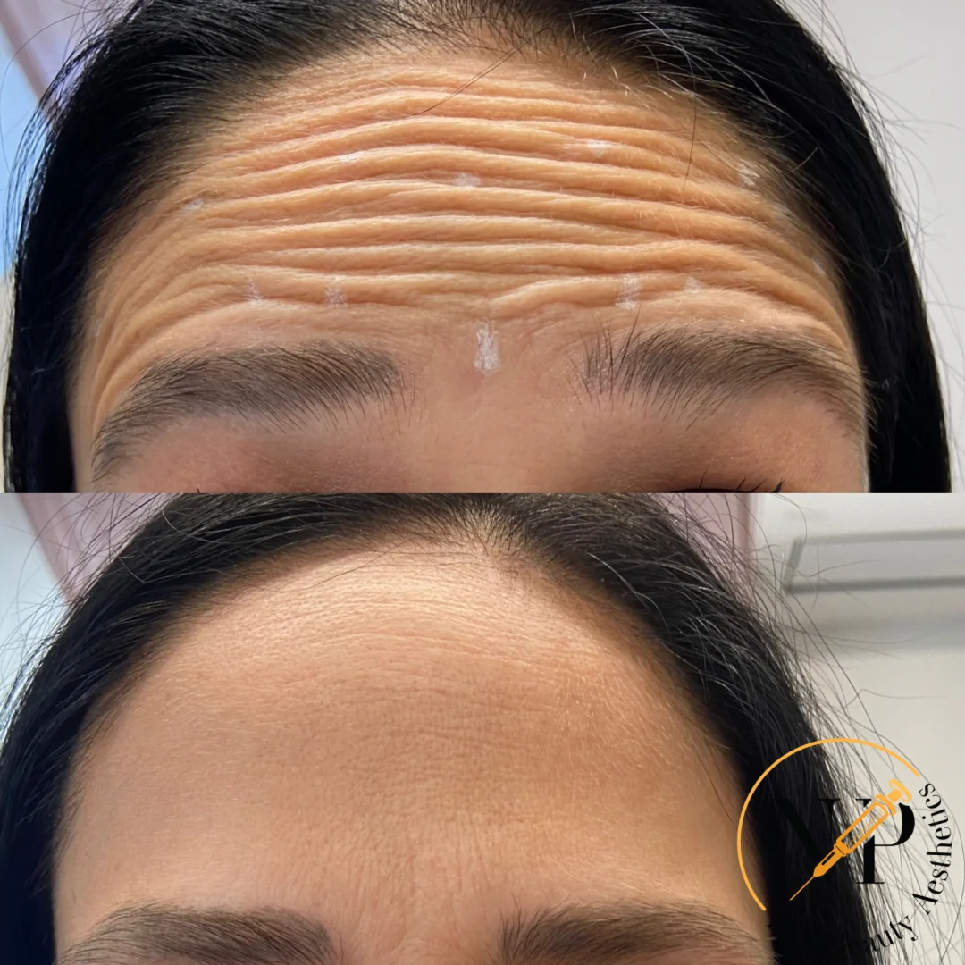 Botox Before & After