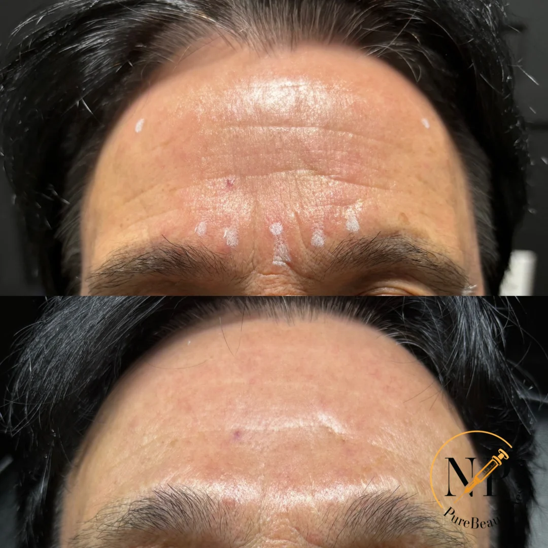Botox Before & After