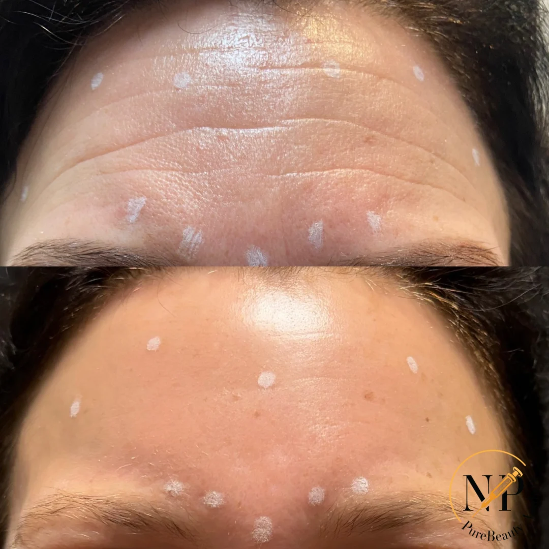 Botox Before & After