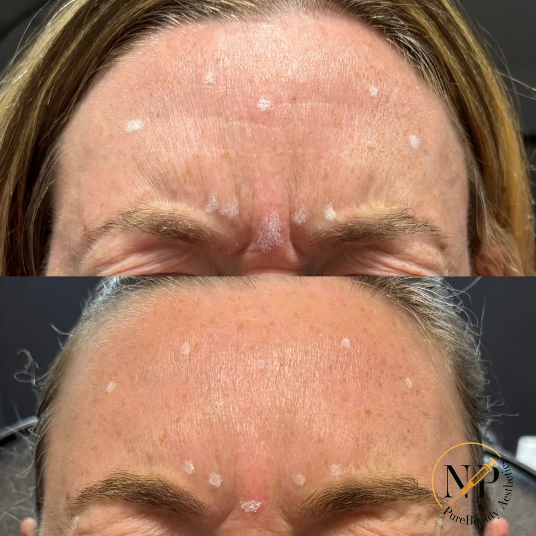 Botox Before & After