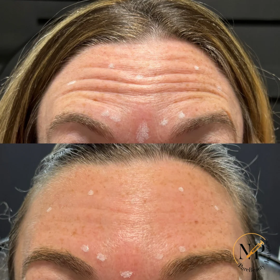 Botox Before & After