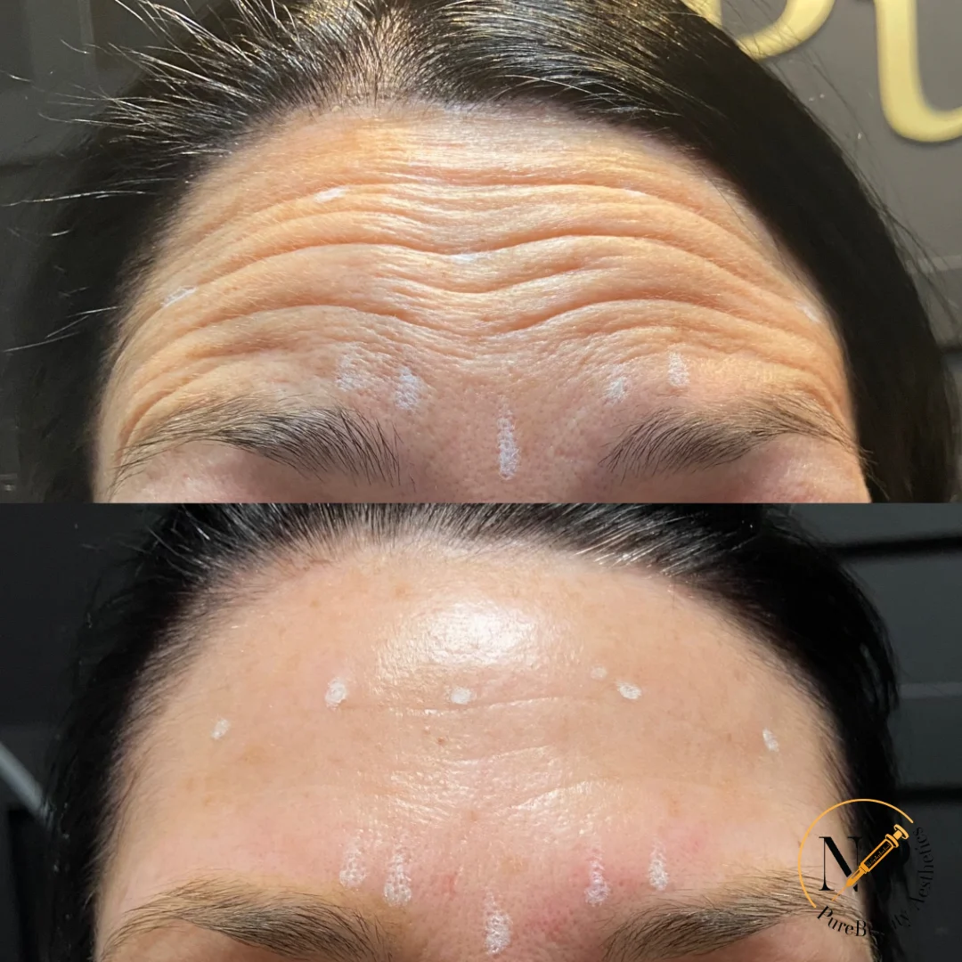 Botox Before & After