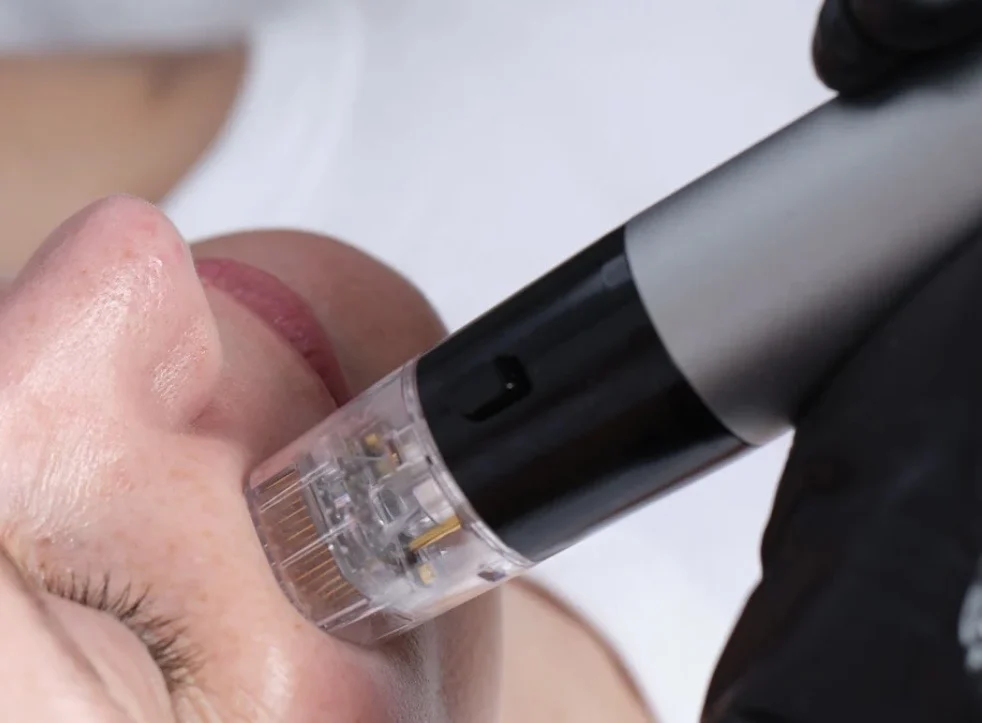 RFMicroneedling