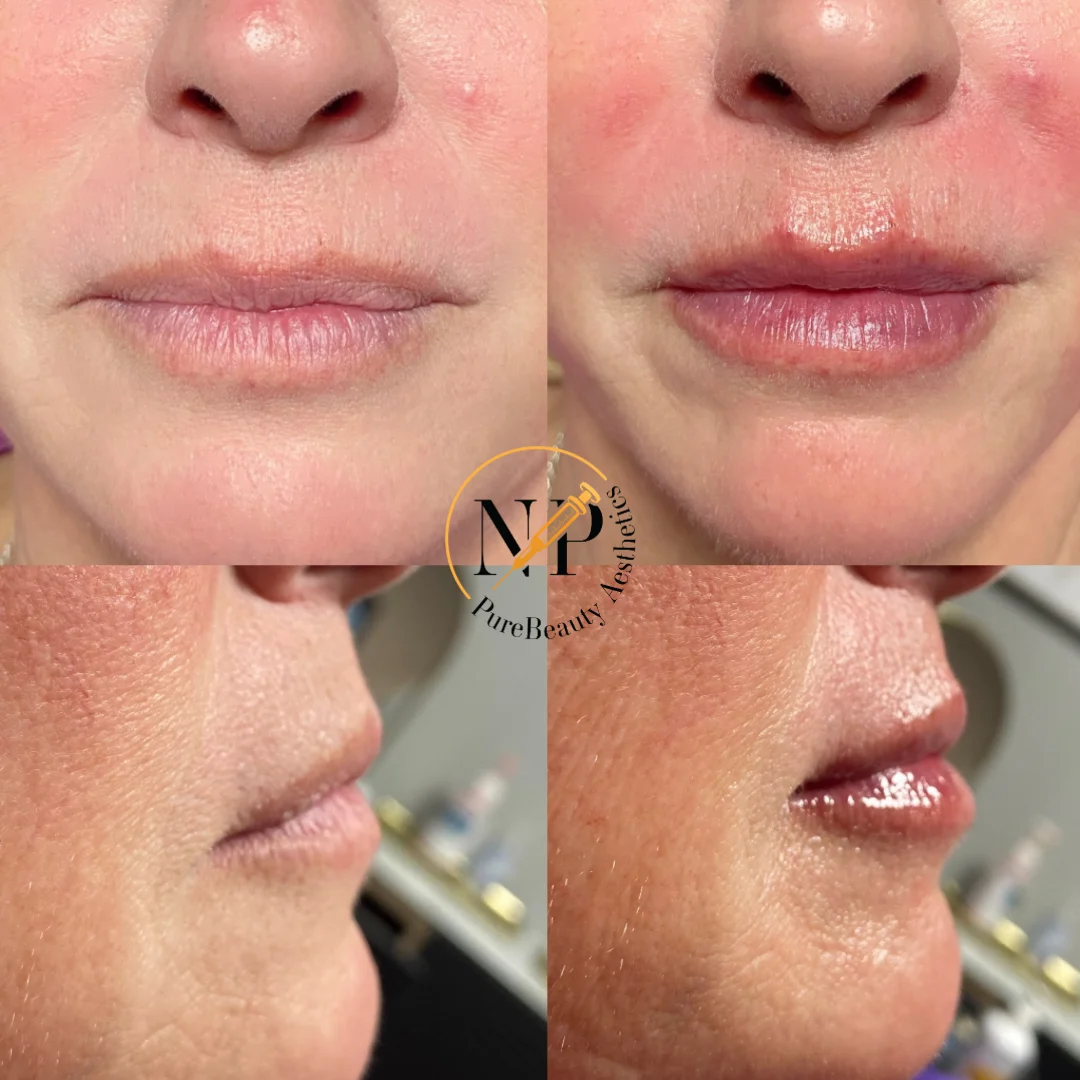 Lips Before & After