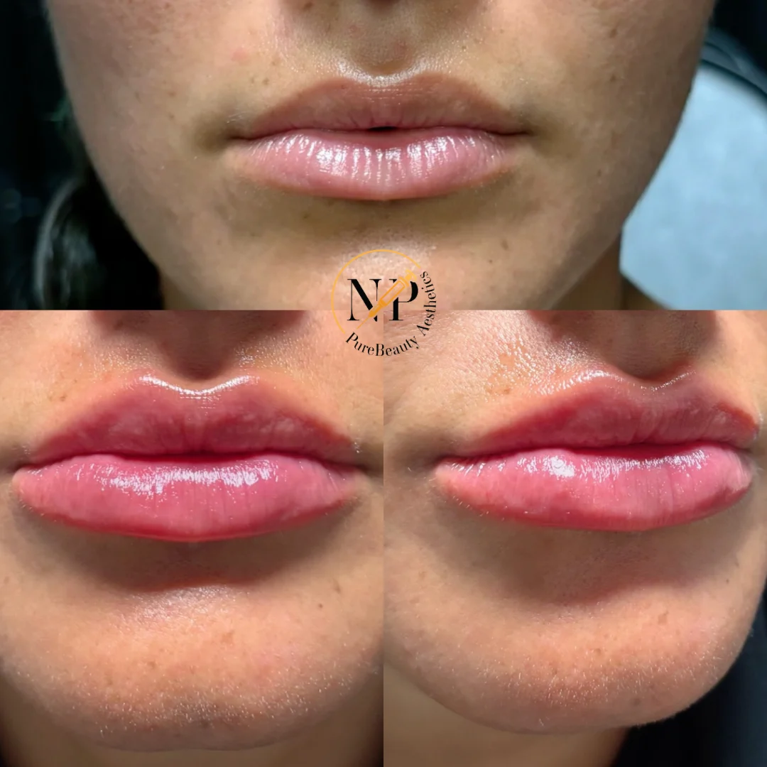 Lips Before & After