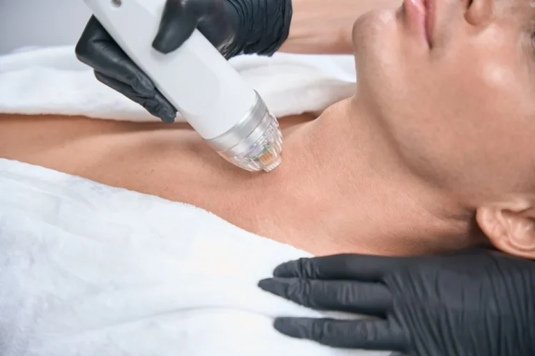 Thanksgiving Prep: RF Microneedling for Glowing, Youthful-Looking Skin